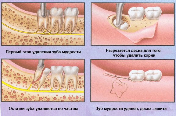 Как режется зуб мудрости фото